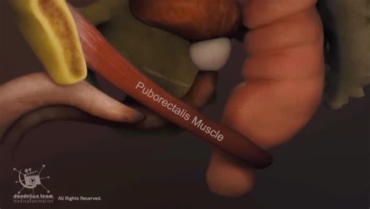 Squatting vs. Sitting: Your Toilet Posture Matters! 🚽✨ Part 1 Did you know the way you “go” can seriously impact your gut health? For thousands of years, squatting was the standard, and there’s a good reason why! Our animated video breaks down the science: → The Sitting Problem: Keeps the anorectal angle bent (80-90°), forcing you to strain and increasing the risk of issues like hemorrhoids and fissures. → The Squatting Solution: Relaxes the puborectalis muscle, straightening the angle (100-110