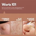 All Types of Genital Warts