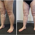 Thigh Lift Surgery Before and After