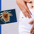 Untreated Pubic Lice