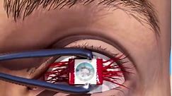 The "tooth in eye" procedure, officially known as osteo-odonto-keratoprosthesis (OOKP), is a highly specialized and intricate surgical technique designed to restore vision in patients with severe corneal damage. This procedure is particularly aimed at those who are not candidates for traditional corneal transplants due to conditions like severe ocular surface disease, chemical burns, or autoimmune disorders that affect the eye.Development and BackgroundOOKP was developed in the 1960s by Italian 