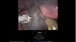 Robotic Resection of Segment VI Hepatocellular Carcinoma in a Cirrhotic Liver with Intracorporeal Pringle Maneuver • Video • MEDtube.net