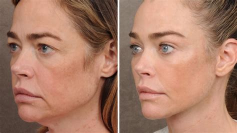 Beverly Hills' Denise Rich's Facelift Is Healed … She Looked 10 Years ...