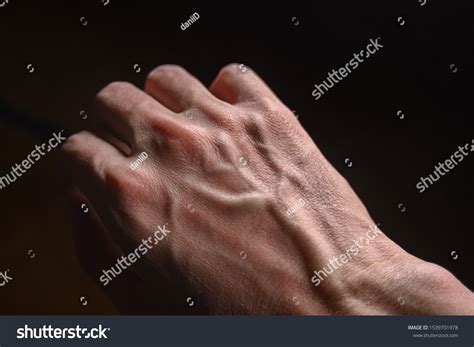 4,021 Moisture Eczema Royalty-Free Images, Stock Photos & Pictures ...