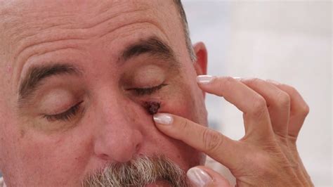 Dr. Pimple Popper: The mysterious bump on James' cheek loves to bleed. Discovery TLC ThisIsZit ...