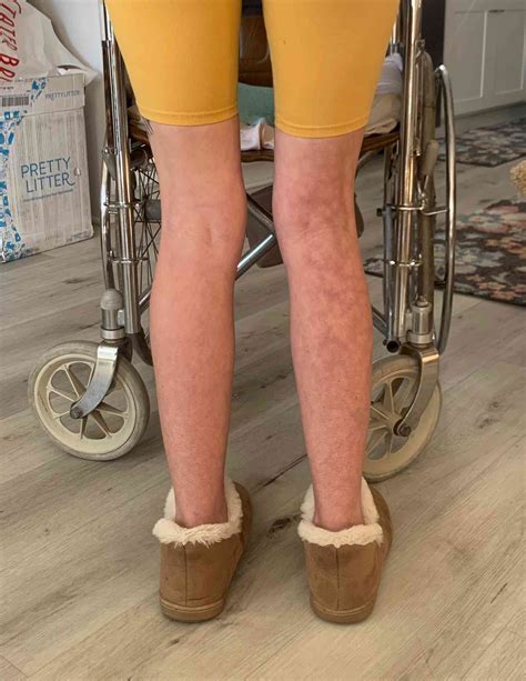 Mom Disabled from Fluoroquinolone Toxicity After Antibiotic (Exclusive)