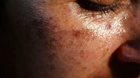 Why Pigmentation Is More Common in Indian Skin - Juicy Chemistry