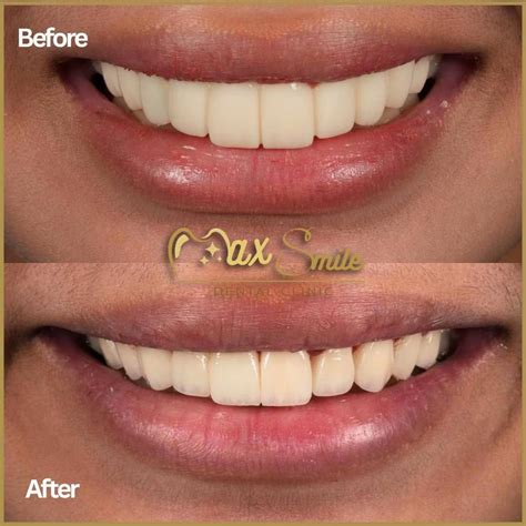 Transform Your Smile with Zirconia Fixed Bridges and Crowns | TikTok