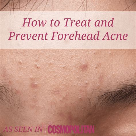 How to Treat and Prevent Forehead Acne | As Seen in Cosmo