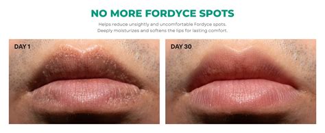 Fordyce Spots Removal Cream – Abera.us