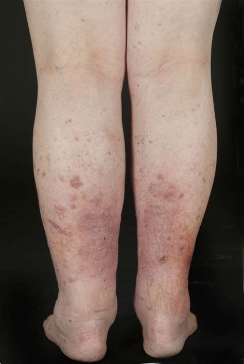 Squamous Cell Carcinoma in Situ - Oncology - MSD Manual Professional Edition