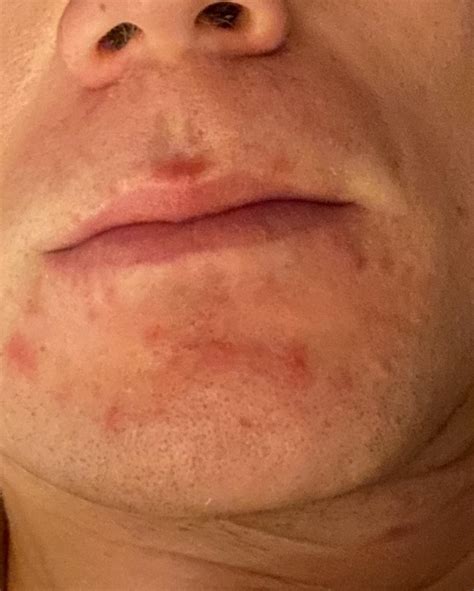 Rosacea or perioral dermatitis ? This only occurs on my chin / close to my mouth. Any advice is ...