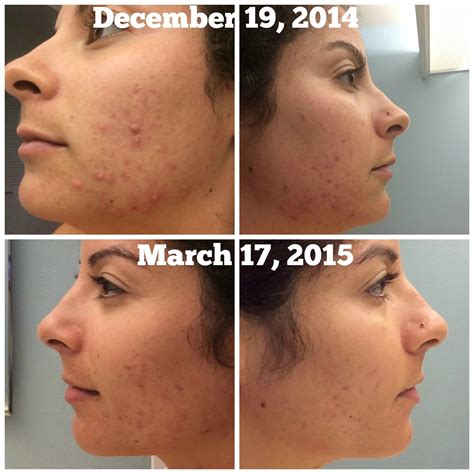 Post Pregnancy Pimples