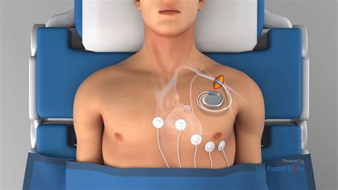 Pacemaker Video | Medical Video Library