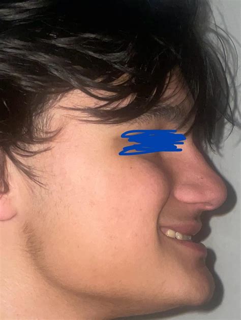 Short face syndrome? Im 16 and here are some photos with my teeth touching, my mom says its ...