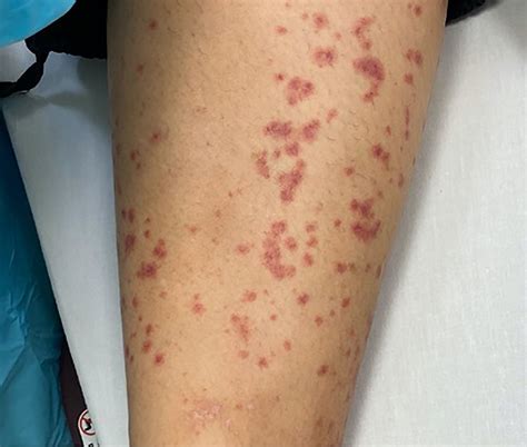 Rash From Dirt at Ronald Mulligan blog