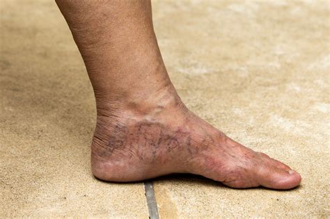 Blue Bulging Veins On Foot Discount | emergencydentistry.com