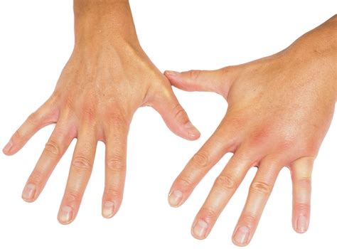Swollen Hands in the Morning caused by Arthritis and other conditions