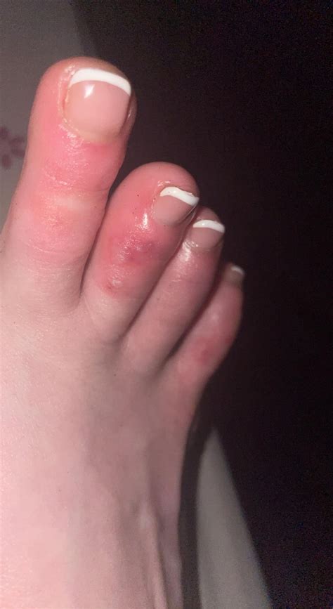 Extremely itchy toes please help ! So I have the worst itchy toes ever !! They are swollen and ...