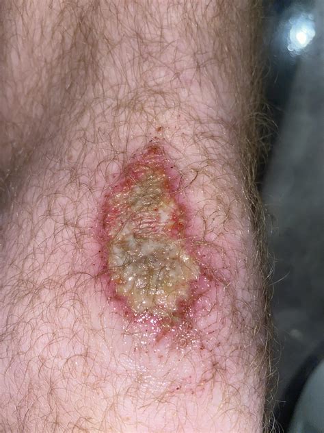 Why Is My Turf Burn Yellow at Dominic Chumleigh blog