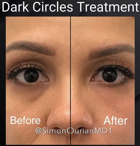 What Causes Dark Circles Under Eyes How To Get Rid Of Them Does A Lack