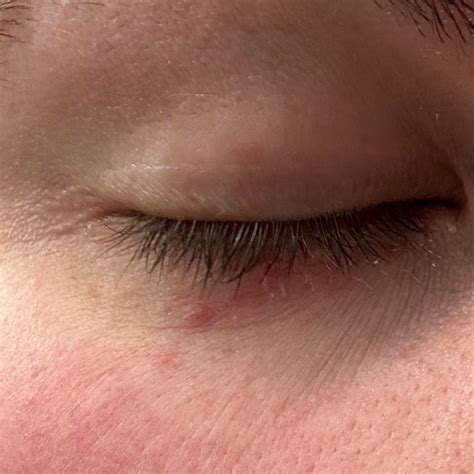 Small red bumps/rash under eye. Has been coming and going for a while ...