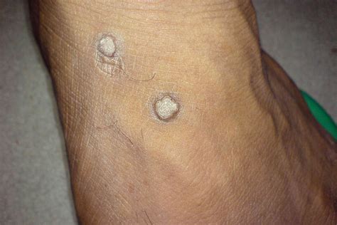 Genital Wart Vs Skin Tag