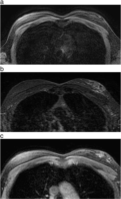 Traumatic fat necrosis of male breast - Clinical Imaging