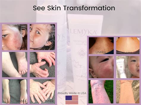 LEMKA Rosacea Cream - Natural Healing for Facial Australia | Ubuy