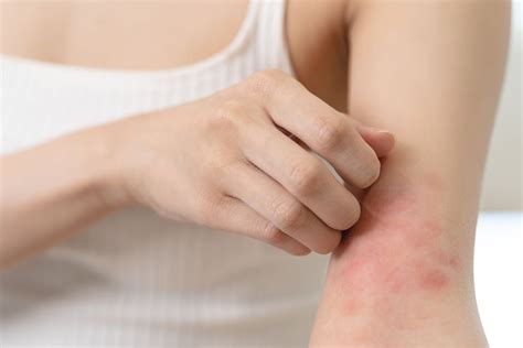 What Causes Eczema To Flare Up? - London Medical