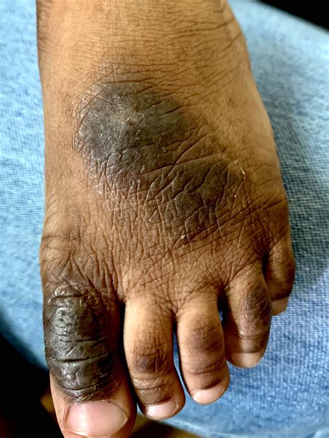 Pathology Outlines - Lichen simplex chronicus