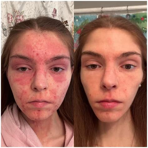 Best Skin Care Tips For Eczema — Mindful Beauty