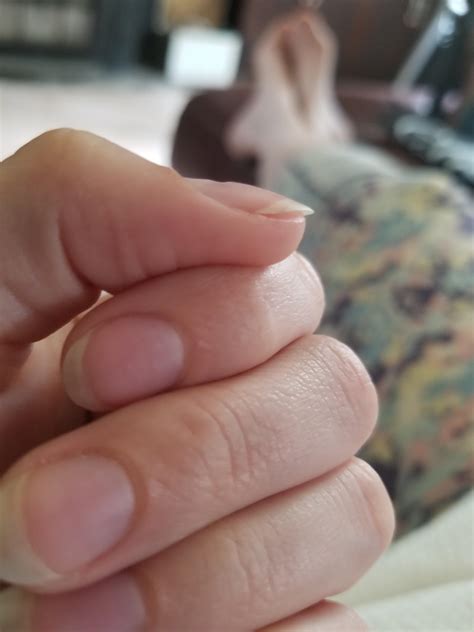 Why Do I Have Bumps On Nails at Hector Dwight blog
