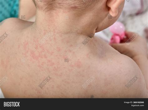 Roseola Rash Toddler
