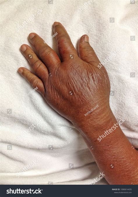 King Cobra Bite Effects