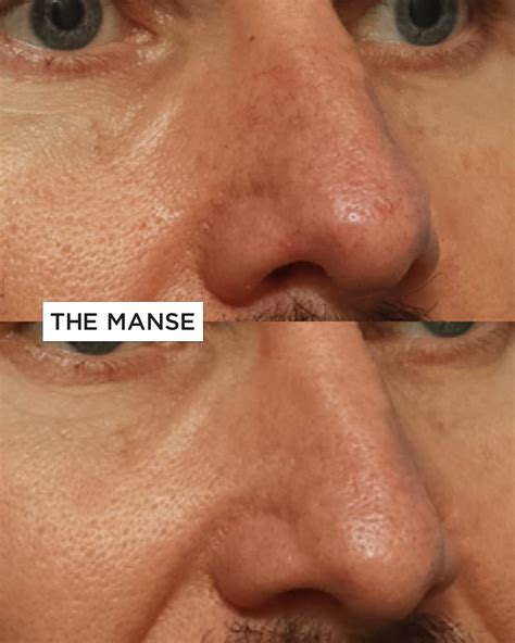 Rosacea Laser Treatment Bruising
