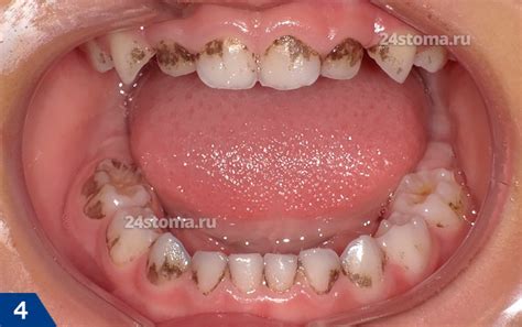 Как удалить пятна от чая с зубов - советы стоматологов - coffee-mir.ru