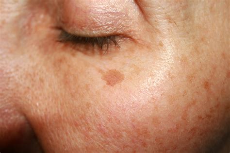 Sunspots On Face Treatment