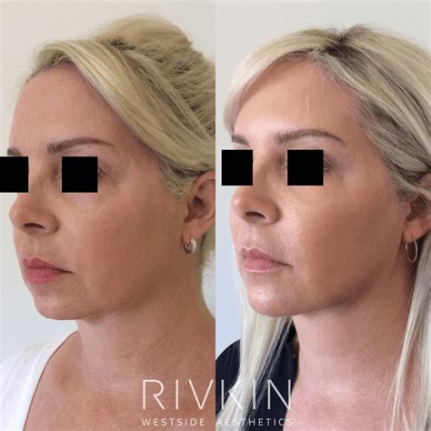 Non Surgical Facelift - RIVKIN Aesthetics