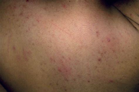 Heat Rash vs Eczema: Symptoms, Causes, Treatment