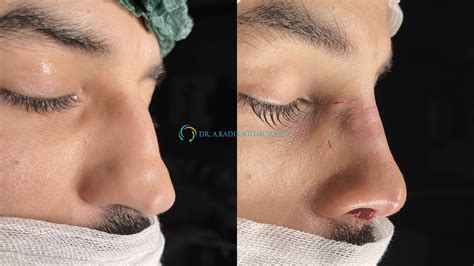 Nose Cartilage Removal Does Your Nose Keep Growing After Rhinoplasty