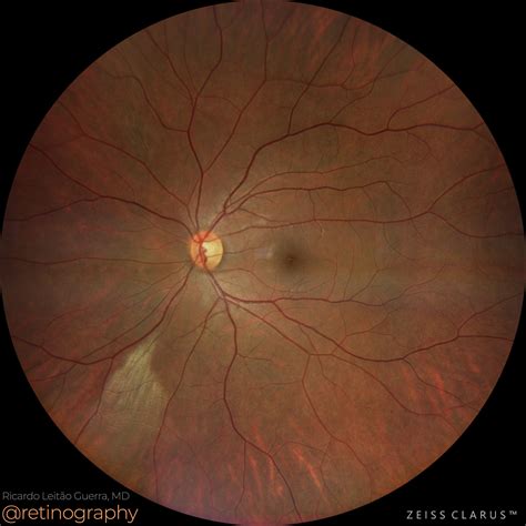 Persistence of myelinated nerve fibers – Retinography - layers of nerve fibre