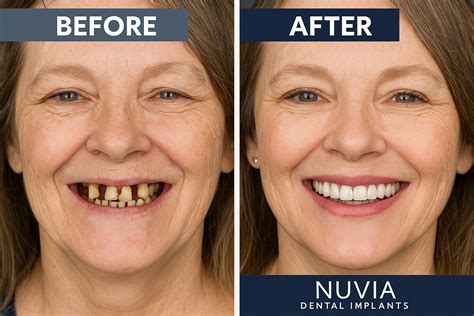 How Much Do Nuvia Dental Implants Cost? 2025 Pricing Guide