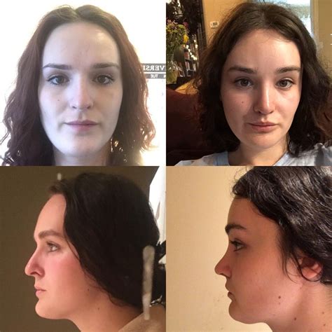 Facial feminization surgery | Vintologi