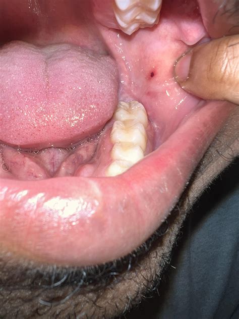 Blood Blister In Cheek