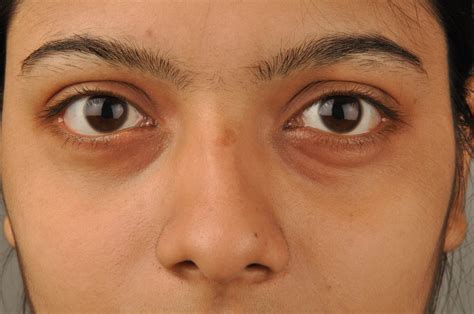 Why Is The Skin Under My Eyes Getting Darker - Infoupdate.org
