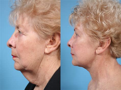 Our Top Neck Lift Before and After Photos (Plus 5 Things To Look For) – TLKM Plastic Surgery