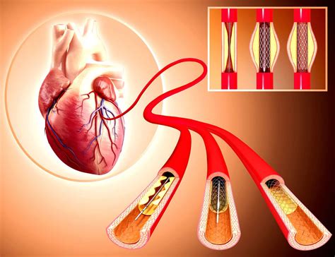 Survival Rate After Heart Stent Placement