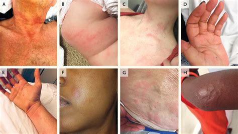 Vancomycin Infusion Reaction — Moving beyond "Red Man Syndrome" | New ...