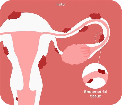 Getting Pregnant with Endometriosis: Success Stories